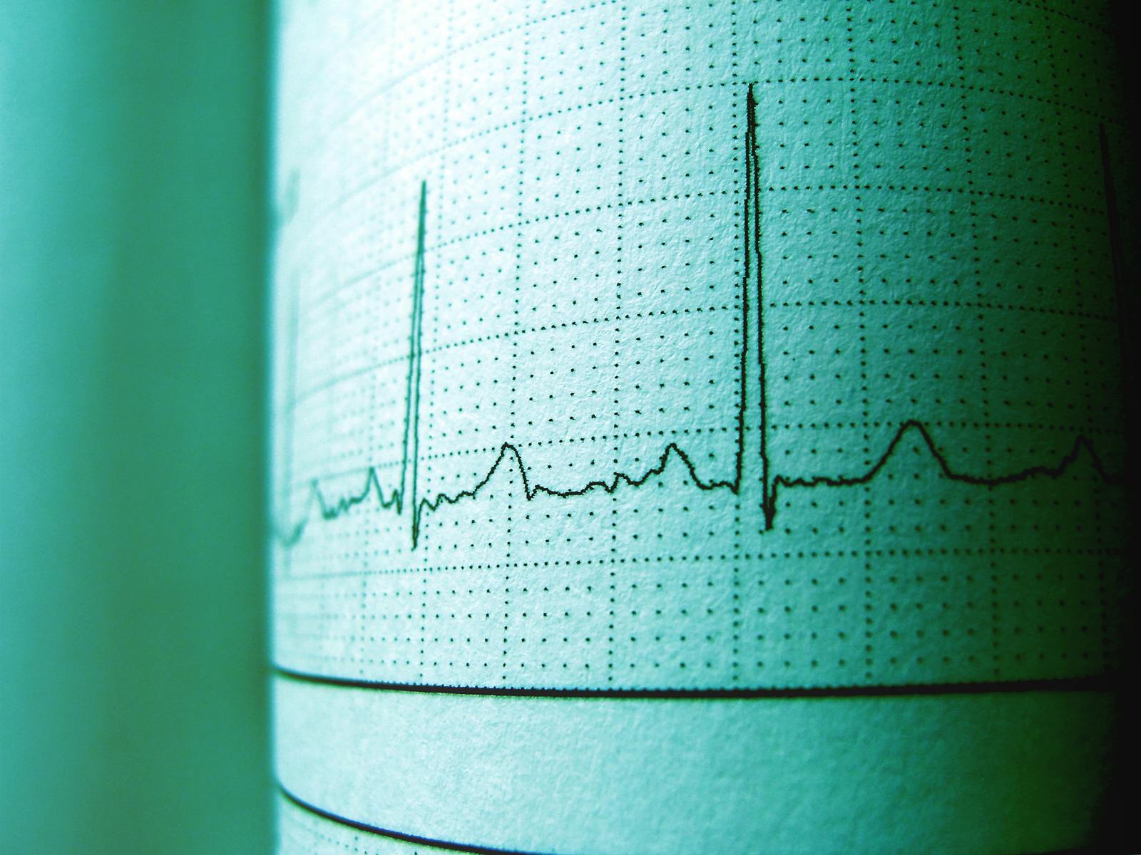 Electrocardiogram tracing printout showing heart rhythm